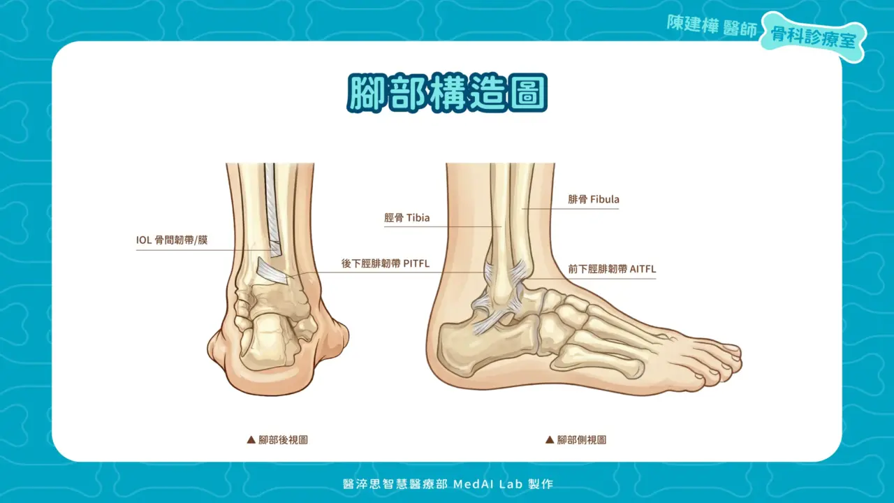 腳部構造解剖圖:顯示高位腳踝扭傷受損位置,包含下脛腓聯合韌帶(前下脛腓韌帶 AITFL、後下脛腓韌帶 PITFL、骨間韌帶 IOL)、脛骨與腓骨結構。